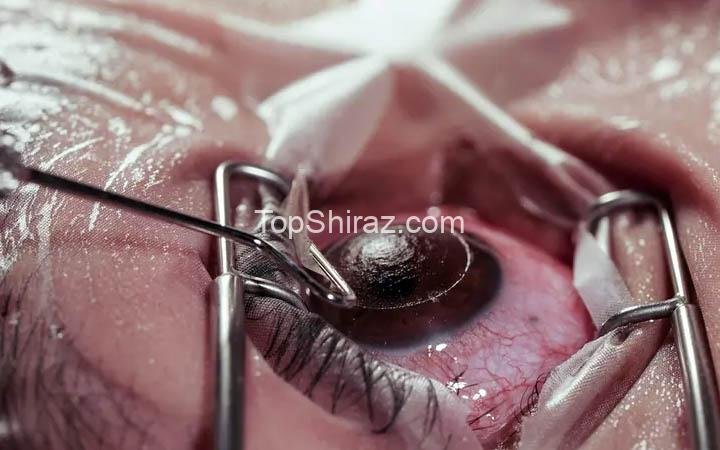 معایب عمل لازک