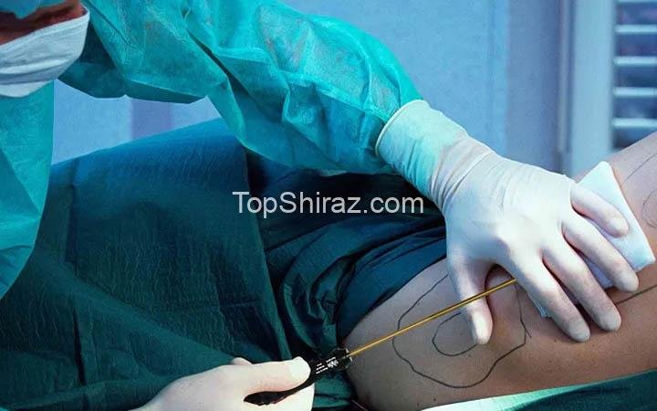 لیپوساکشن و پیکرتراشی